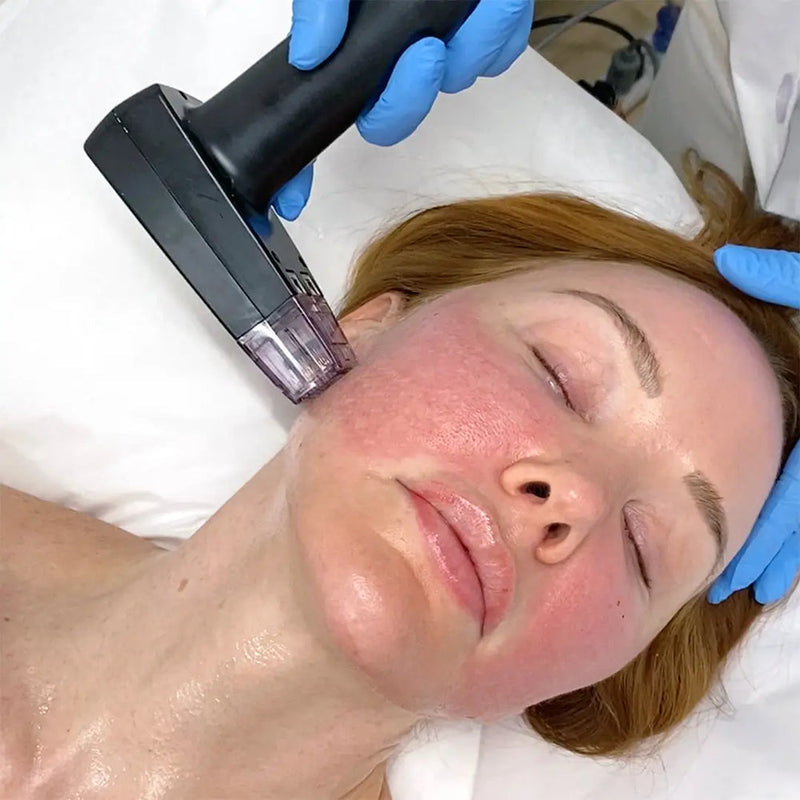 RF MICRONEEDLING (MORPHEUS)